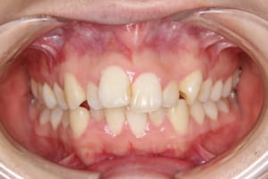 前歯がたがたがし、上の前歯が唇側へ出ています。
